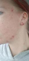 Acne looking skin disorder on the side of face and jaw.