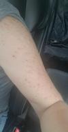 Acne looking skin disorder on arm.