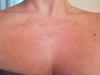 Rash on chest with pus filled postules.
