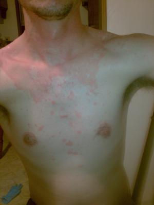 Undiagnosed Non Itchy Skin Rash on Chest