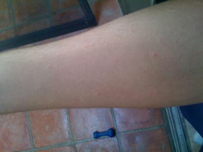 unexplained rash on the forearm