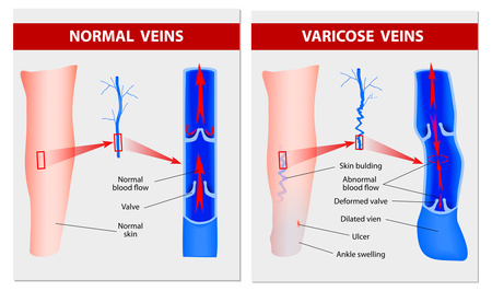 normal and varicose veins schematic diagrams