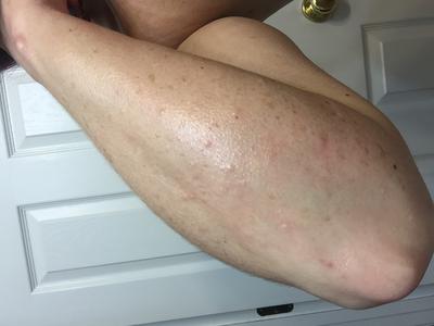 Itchy welts present on arm.