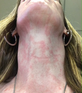 Red non-itchy rash on neck.