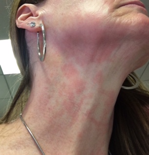 Neck and face red rash that does not itch.