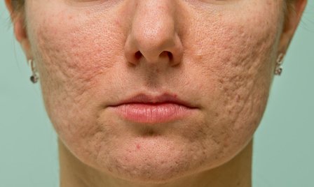 acne scars on cheeks of woman's face