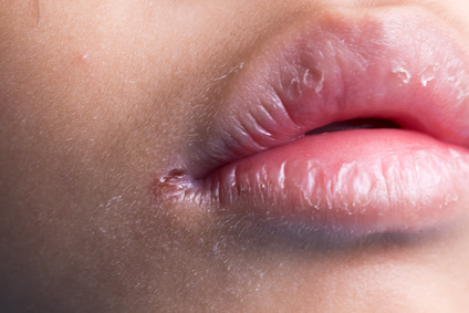 angular cheilitis lip skin care problem at the corner of the mouth