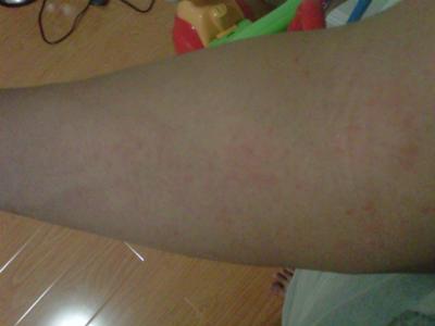 sweat rash on arm when it first appears