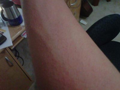 swollen sweat rash on arm