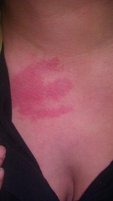 Burning bright red skin rash on chest.