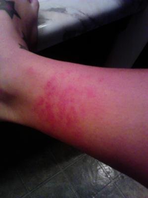 burning red skin rash on leg