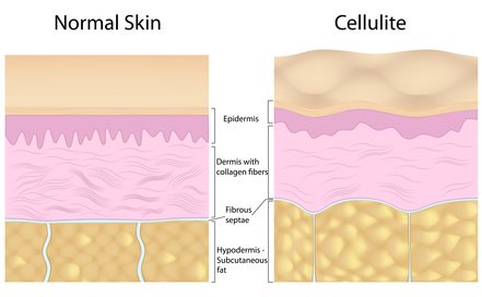 schematic diagram of normal skin layers and skin layer with the cellulite skin problem
