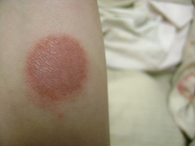 Unknown Circular Skin Rash on Arm
