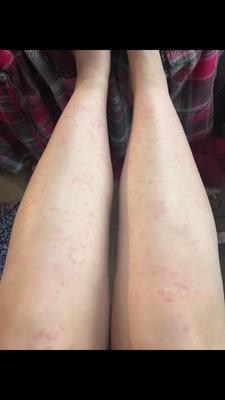 Circular or crescent shaped rash on legs.