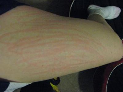 image of dermatographism on the leg with no raised skin and only red marks