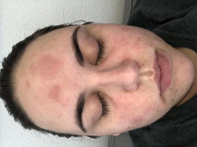 Woman's face with red hives or rash