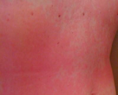 Possible Food Poisoning Skin Rash