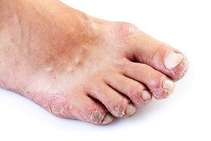 foot rash on toes caused by a variety of factors