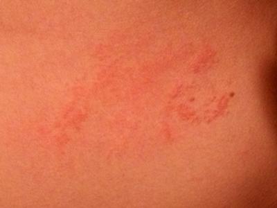 close up of skin rash on stomach