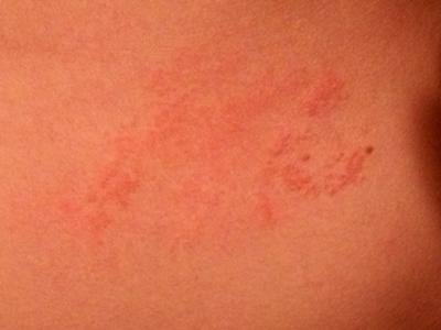 close up of skin rash on stomach