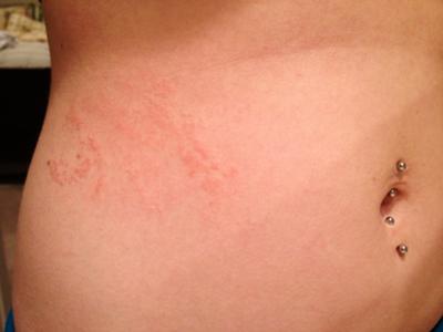 possible fungal skin rash on stomach area