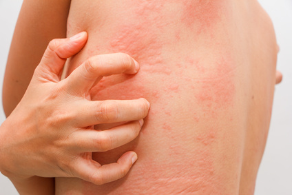 itchy hives or welts or rash on body caused by a food allergy rash