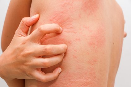 itchy hives or welts or rash on body caused by a food allergy rash