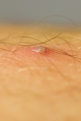 pimple caused by an ingrown hair