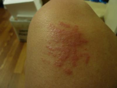 rash skin itchy rashes abrasion leg after itch children adults face bumps causes arms itching chest kids neck dogs hands