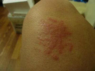 Itchy Skin Rash After Skin Abrasion