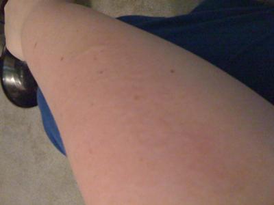 Skin rash on arm