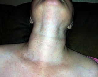 A neck rash that is spreading to the chin.