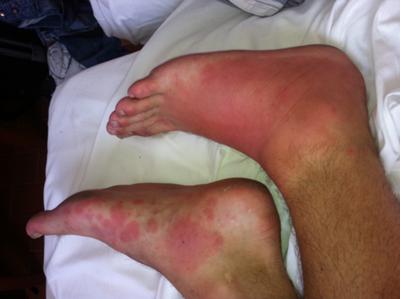 Painful Red Skin Rash on Foot