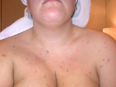 Pox like Spots Skin Rash on Chest 