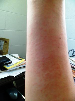 Possible prickly heat rash on arm.