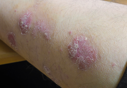 flaky and red psoriasis skin problem on arm
