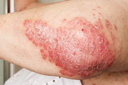 red and flaky psoriasis on elbow or arm requires a psoriasis treatment