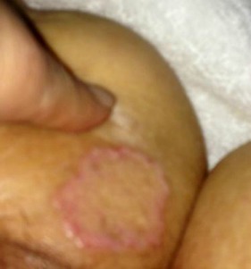 Raised Edge Skin Rash