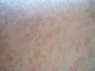 red and blotchy non itching skin rash