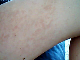 red and blotchy non itchy rash
