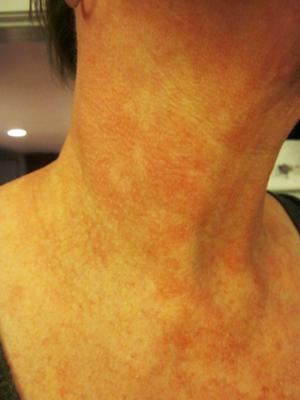 hot red skin rash on neck
