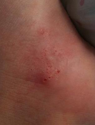 small itchy blisters rash on foot and hands