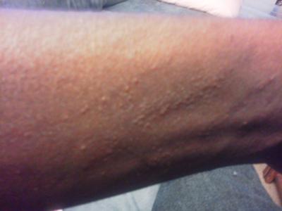 skin rash like a scratch on the skin