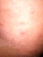 rash on buttocks area