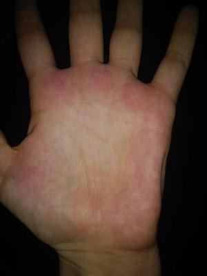 Red skin rash on the palm of the hand.