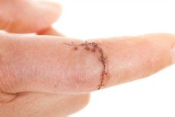 wound will result in a scar on this finger and vitamin e may help fade the scar