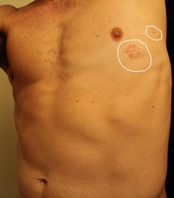 Skin rash on chest with fever