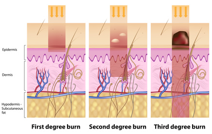 types or severity of skin burns