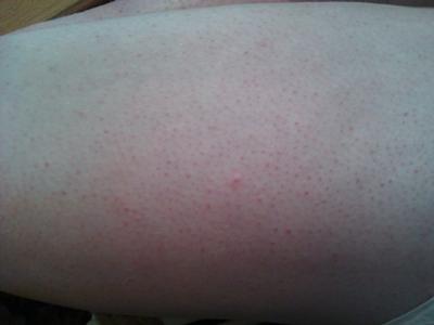 skin rash on leg