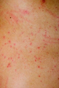 rash of red spot on skin